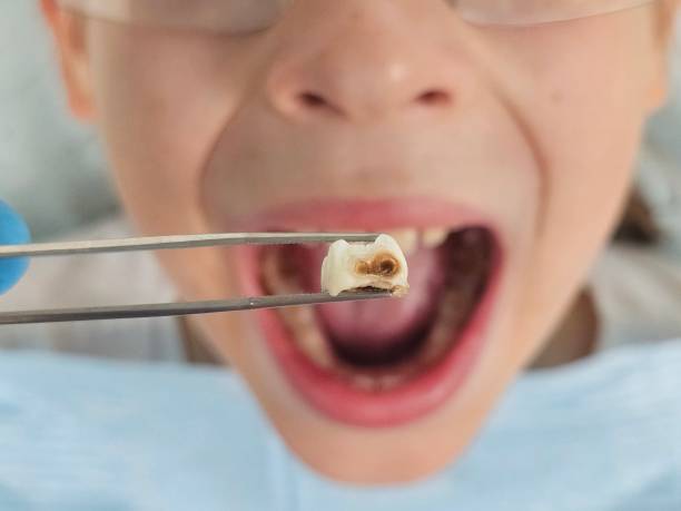 Best Emergency Tooth Extraction  in Wilson, WY