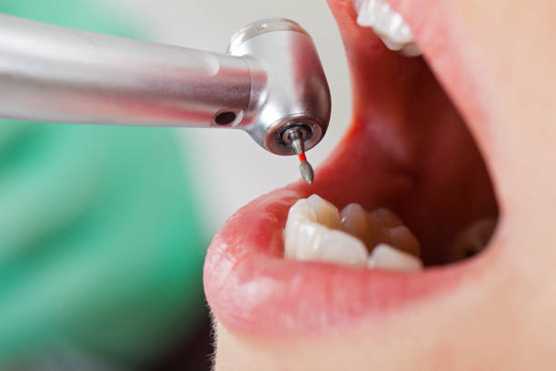 Emergency Dental Filling Replacement in WY